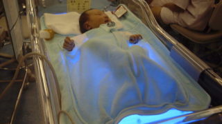 黄疸で集中治療室に