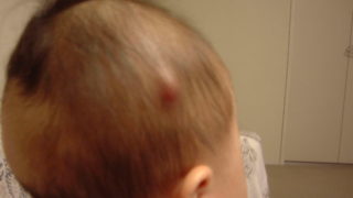 おできができた