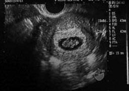 妊娠検診時の超音波写真